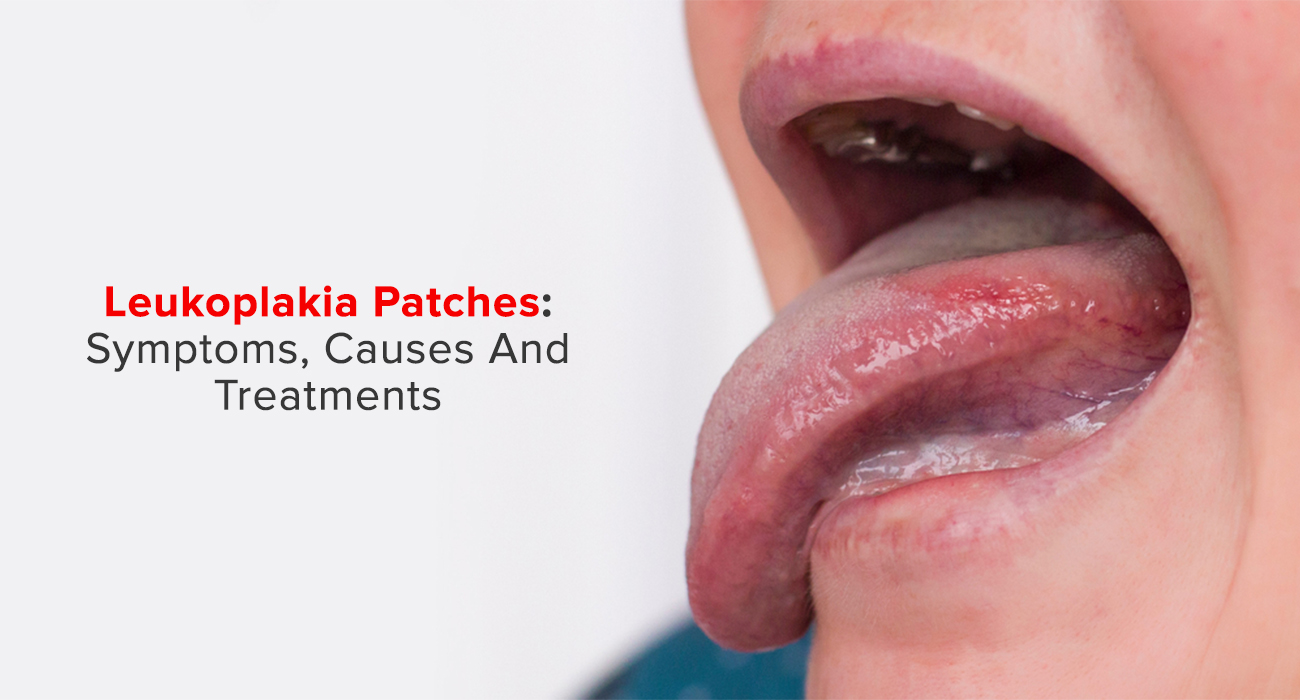 How to Identify & Treat Leukoplakia Patches: A Complete Guide